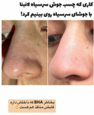 چسب بینی کاسه ای ضد جوش سرسیاه لانبنا ۶۰ عددی