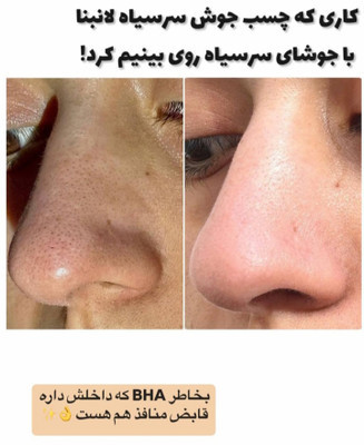 چسب بینی کاسه ای ضد جوش سرسیاه لانبنا ۶۰ عددی